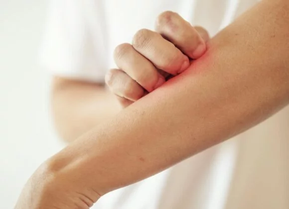 A person scratching an itchy, red patch on their forearm with their other hand.