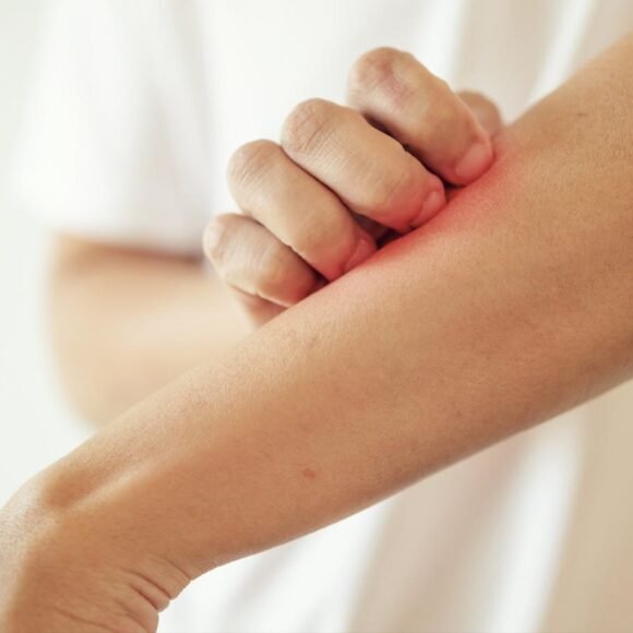 A person scratching an itchy, red patch on their forearm with their other hand.