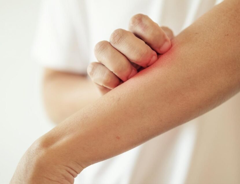 A person scratching an itchy, red patch on their forearm with their other hand.