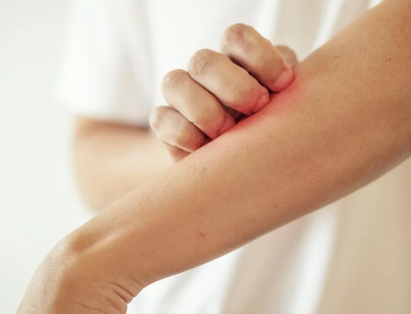 Atopic Dermatitis Symptoms: Causes and Care Tips A person scratching an itchy, red patch on their forearm with their other hand.