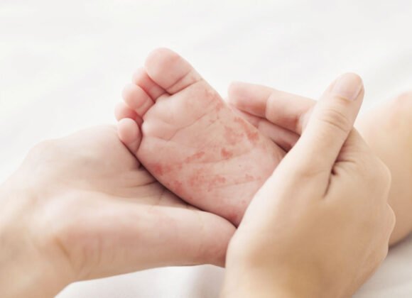 Baby Eczema: How Symptoms Develop in Infants Two hands hold a small foot with a red rash on the sole, highlighting the irritation, potentially caused by eczema triggers. The background is blurred and light-colored.