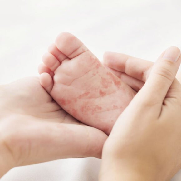 Two hands hold a small foot with a red rash on the sole, highlighting the irritation, potentially caused by eczema triggers. The background is blurred and light-colored.