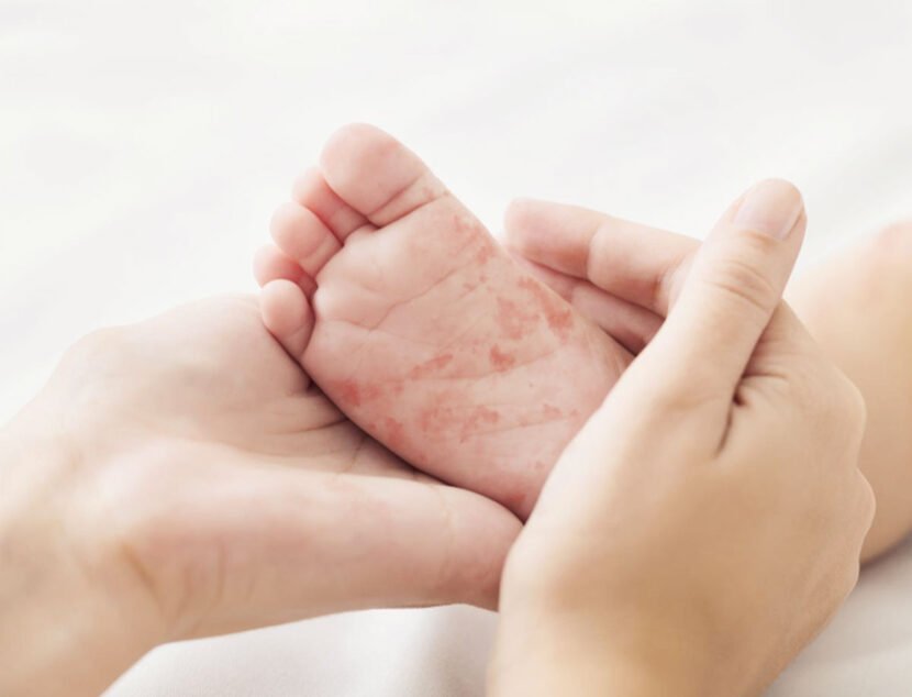 Two hands hold a small foot with a red rash on the sole, highlighting the irritation, potentially caused by eczema triggers. The background is blurred and light-colored.