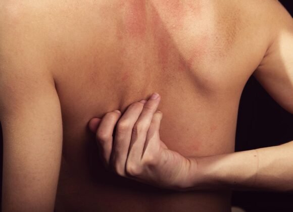 A person scratching their bare back reveals dry patches and reddish, irritated skin, likely due to back eczema.