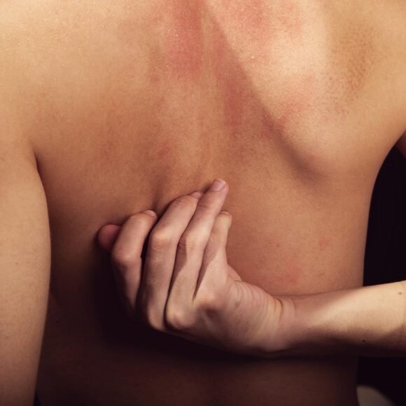A person scratching their bare back reveals dry patches and reddish, irritated skin, likely due to back eczema.