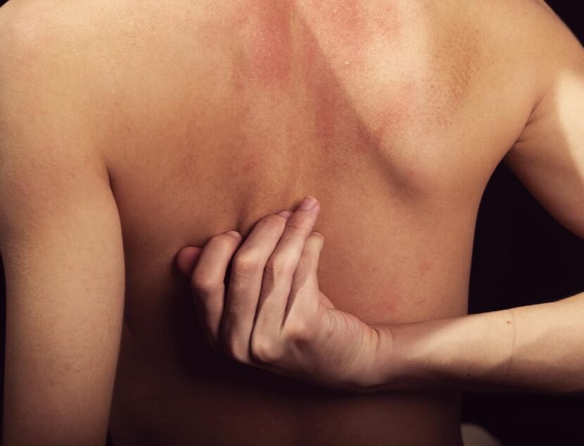 Back Eczema: Symptoms and Common Irritants A person scratching their bare back reveals dry patches and reddish, irritated skin, likely due to back eczema.