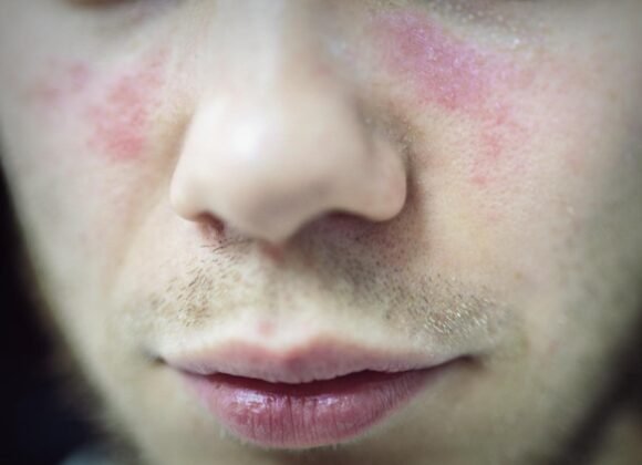 Close-up of a person's face showing red, irritated skin on the cheeks and around the nose, with light facial hair and slightly chapped lips.