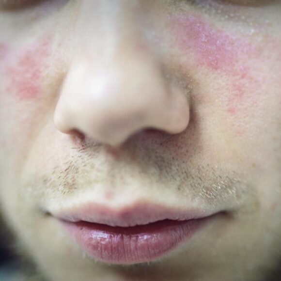 Close-up of a person's face showing red, irritated skin on the cheeks and around the nose, with light facial hair and slightly chapped lips.