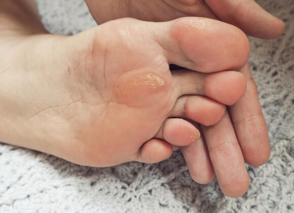 Close-up of a hand touching a foot with calluses on the sole. The skin appears rough and dry, particularly around the ball of the foot. The foot is resting on a textured gray surface.