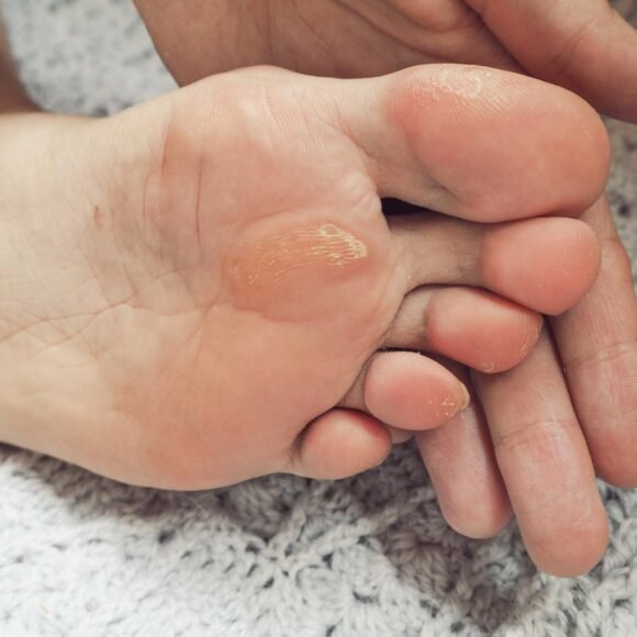Close-up of a hand touching a foot with calluses on the sole. The skin appears rough and dry, particularly around the ball of the foot. The foot is resting on a textured gray surface.