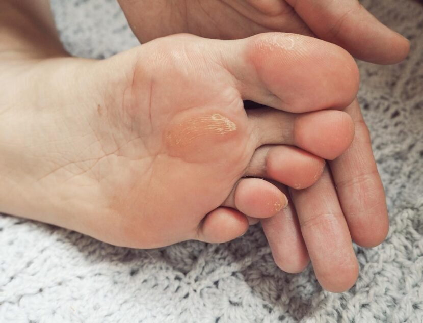Dyshidrotic Eczema: The Symptoms of Hand and Foot Blisters Close-up of a hand touching a foot with calluses on the sole. The skin appears rough and dry, particularly around the ball of the foot. The foot is resting on a textured gray surface.