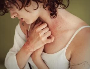 Person with curly hair shows a red, itchy rash on their neck and hands while wearing a white tank top, highlighting the importance of eczema prevention.