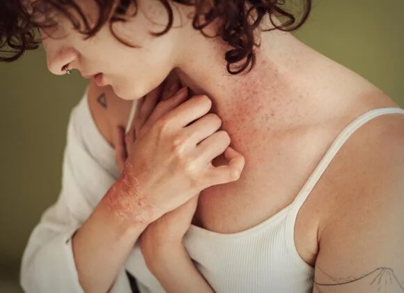 Person with curly hair shows a red, itchy rash on their neck and hands while wearing a white tank top, highlighting the importance of eczema prevention.