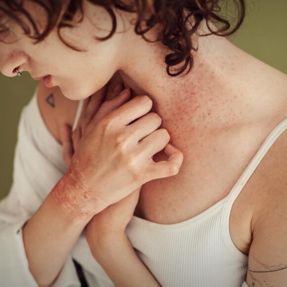 Person with curly hair shows a red, itchy rash on their neck and hands while wearing a white tank top, highlighting the importance of eczema prevention.