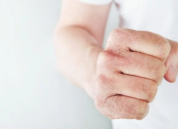 Close-up of a hand with dry, flaky skin and visible irritation from itchy skin, shown in a fist position against a plain background. The person is wearing a white short-sleeved shirt.