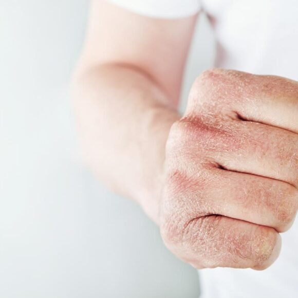 Close-up of a hand with dry, flaky skin and visible irritation from itchy skin, shown in a fist position against a plain background. The person is wearing a white short-sleeved shirt.