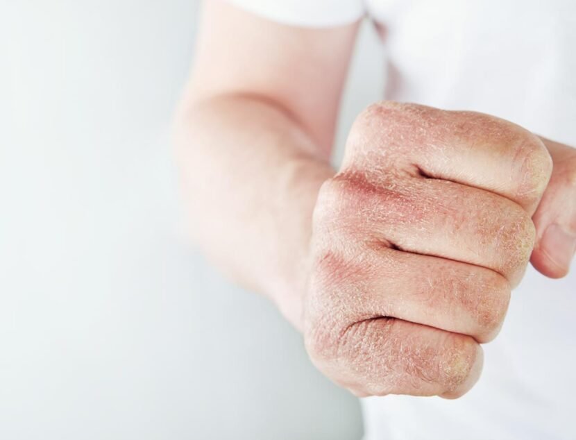 Eczema on the Hands: Symptoms and Best Treatment Practices Close-up of a hand with dry, flaky skin and visible irritation from itchy skin, shown in a fist position against a plain background. The person is wearing a white short-sleeved shirt.