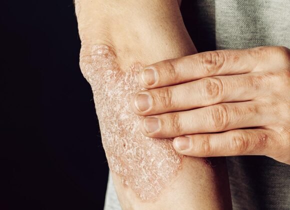 Eczema on Elbows: Spotting Early Symptoms and Prevention A person touches a patch of dry, flaky skin on their forearm, indicative of eczema triggers.