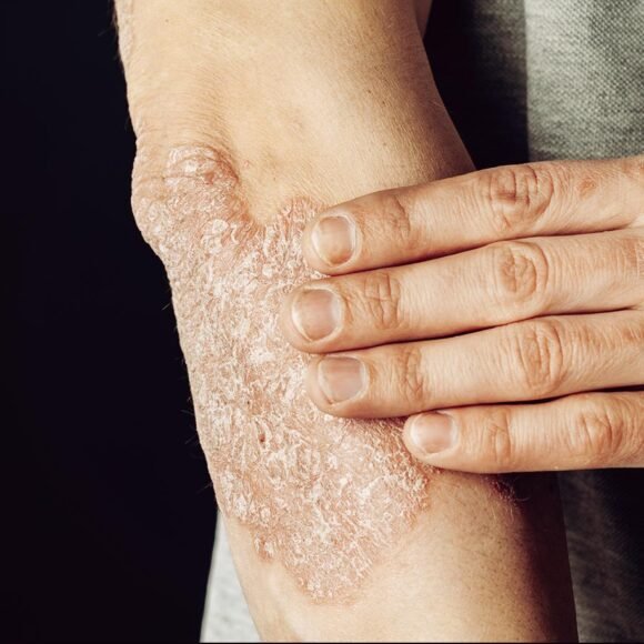 A person touches a patch of dry, flaky skin on their forearm, indicative of eczema triggers.
