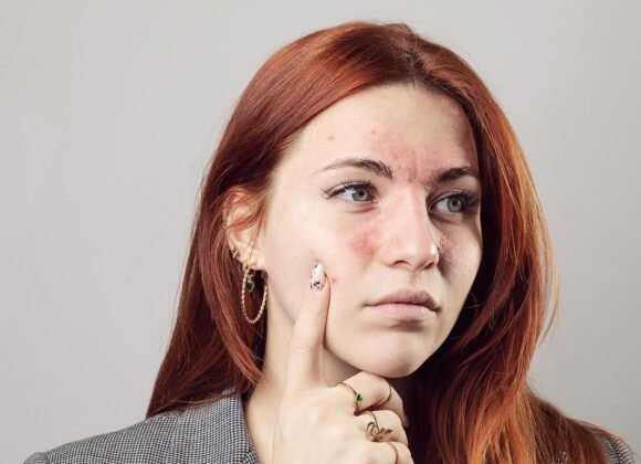 Facial Eczema: How It Affects Sensitive Skin A person with red hair and a serious expression points to facial redness, dry patches, and acne on their cheek against a plain background.