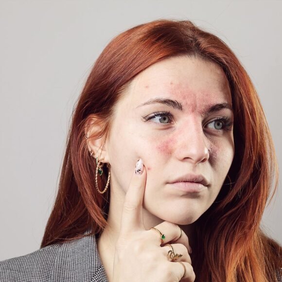 A person with red hair and a serious expression points to facial redness, dry patches, and acne on their cheek against a plain background.