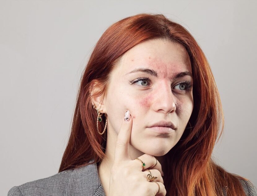 A person with red hair and a serious expression points to facial redness, dry patches, and acne on their cheek against a plain background.