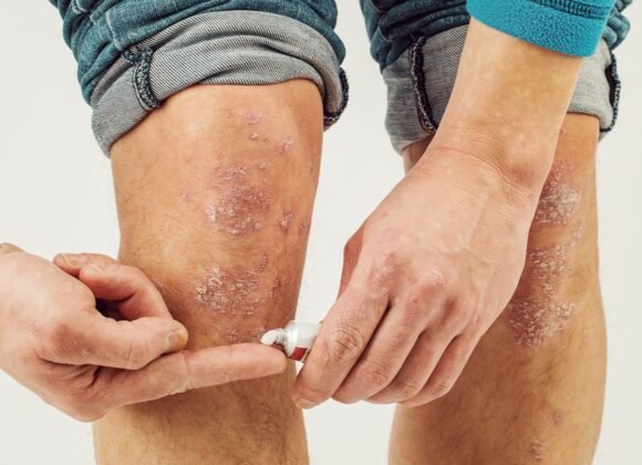 Leg Eczema: Identifying Causes and Effective Treatments A person applies ointment to their knee, which is affected by a skin condition, possibly psoriasis or eczema, trying to soothe the itchy skin and dry patches.