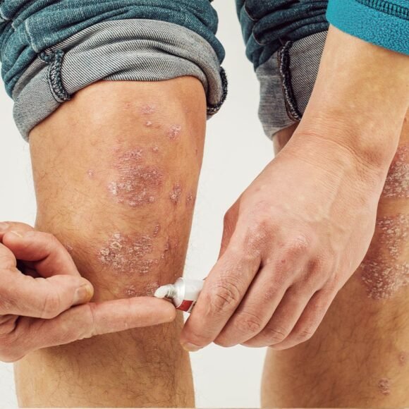 A person applies ointment to their knee, which is affected by a skin condition, possibly psoriasis or eczema, trying to soothe the itchy skin and dry patches.