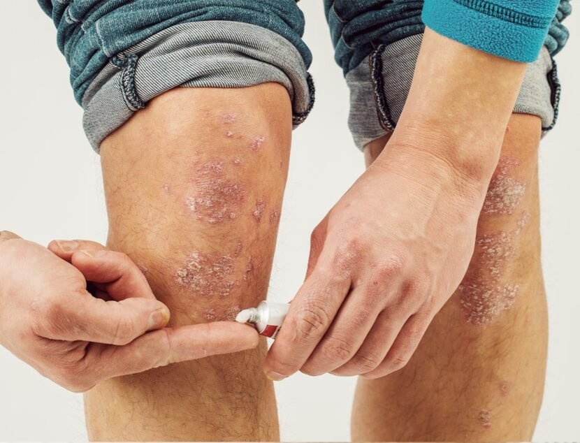 Leg Eczema: Identifying Causes and Effective Treatments A person applies ointment to their knee, which is affected by a skin condition, possibly psoriasis or eczema, trying to soothe the itchy skin and dry patches.