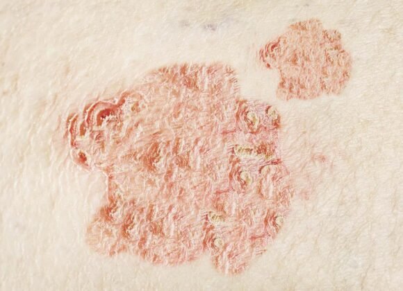 Close-up of a skin condition with red, scaly patches of dry, flaky skin on a pale surface.