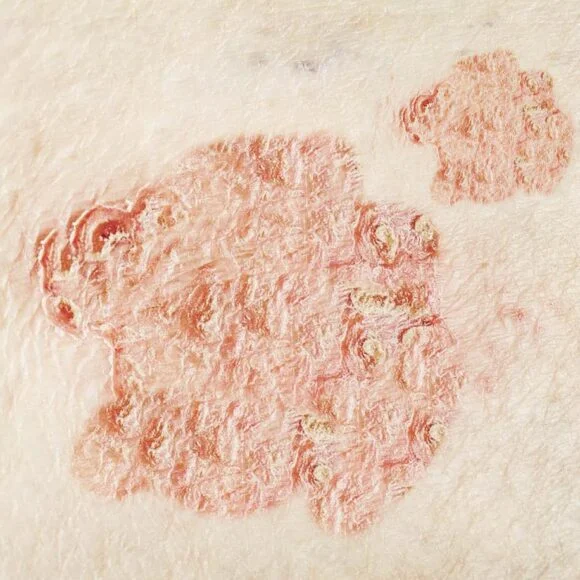 Close-up of a skin condition with red, scaly patches of dry, flaky skin on a pale surface.