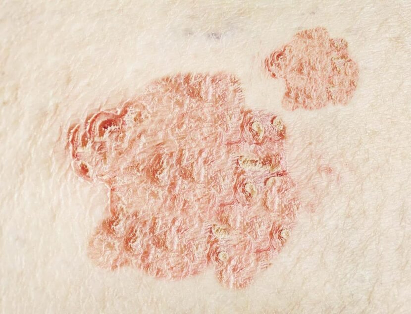 Nummular Eczema: Spotting Its Unique Symptoms Close-up of a skin condition with red, scaly patches of dry, flaky skin on a pale surface.
