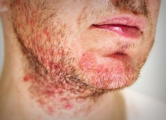 Seborrheic Dermatitis vs Eczema: How Their Symptoms Compare Close-up of a person's lower face and neck showing red, irritated skin with patches of inflamed hair follicles, commonly associated with a rash or skin condition.
