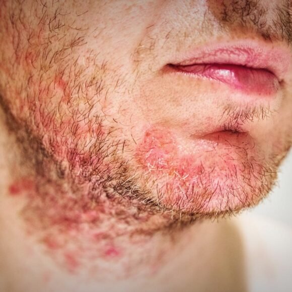 Close-up of a person's lower face and neck showing red, irritated skin with patches of inflamed hair follicles, commonly associated with a rash or skin condition.