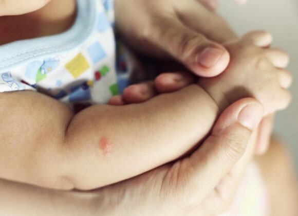 Soothing Eczema Symptoms in Babies and Toddlers Close-up of a baby’s arm with eczema, being gently held by an adult's hands. The baby is wearing a patterned onesie.