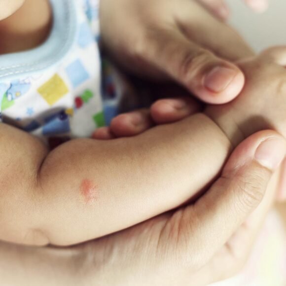 Close-up of a baby’s arm with eczema, being gently held by an adult's hands. The baby is wearing a patterned onesie.
