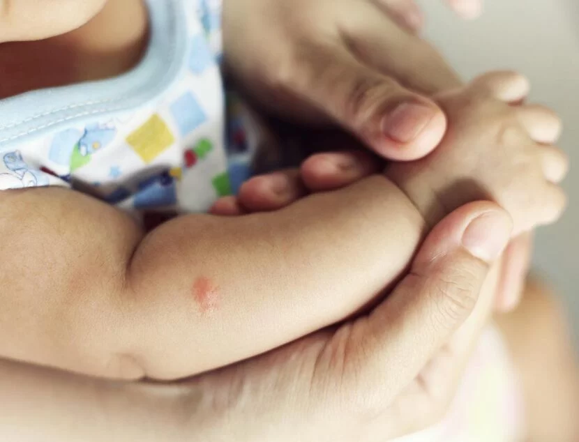 Close-up of a baby’s arm with eczema, being gently held by an adult's hands. The baby is wearing a patterned onesie.