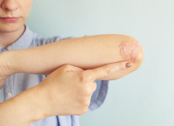 Understanding the Common Symptoms of Eczema Person applying ointment to a dry, irritated patch of skin on their forearm, which appears red and scaly. The background is a plain light blue wall.