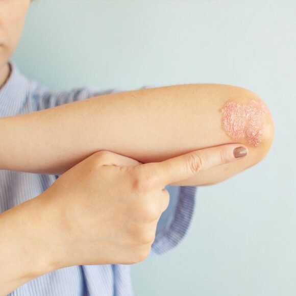 Person applying ointment to a dry, irritated patch of skin on their forearm, which appears red and scaly. The background is a plain light blue wall.