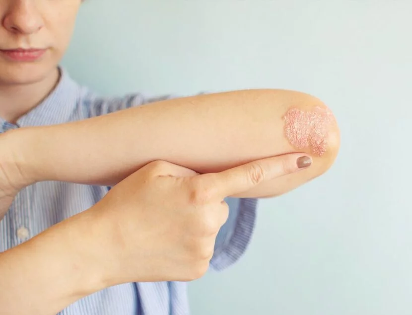 Person applying ointment to a dry, irritated patch of skin on their forearm, which appears red and scaly. The background is a plain light blue wall.